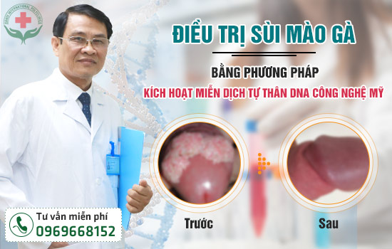 điều trị sùi mào gà ở miệng