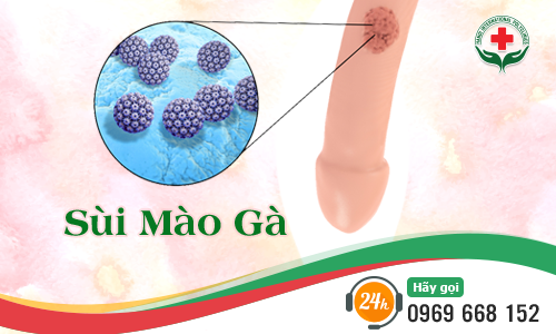 bệnh sùi mài gà là gì