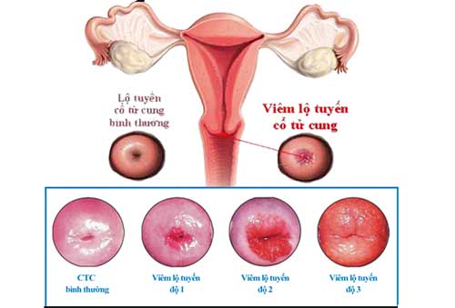 Tổng quan về bệnh viêm lộ tuyến cổ tử cung ở nữ giới